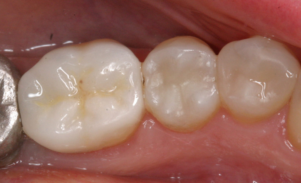 Replacement bonded ceramic restorations