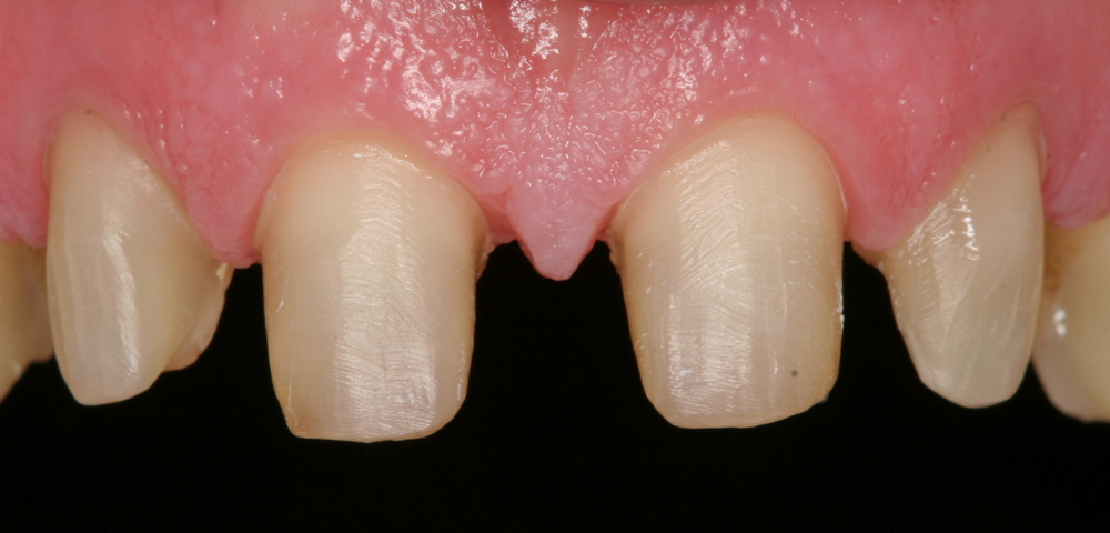 Crown preparations for front teeth