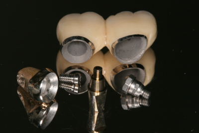 2 implant crowns