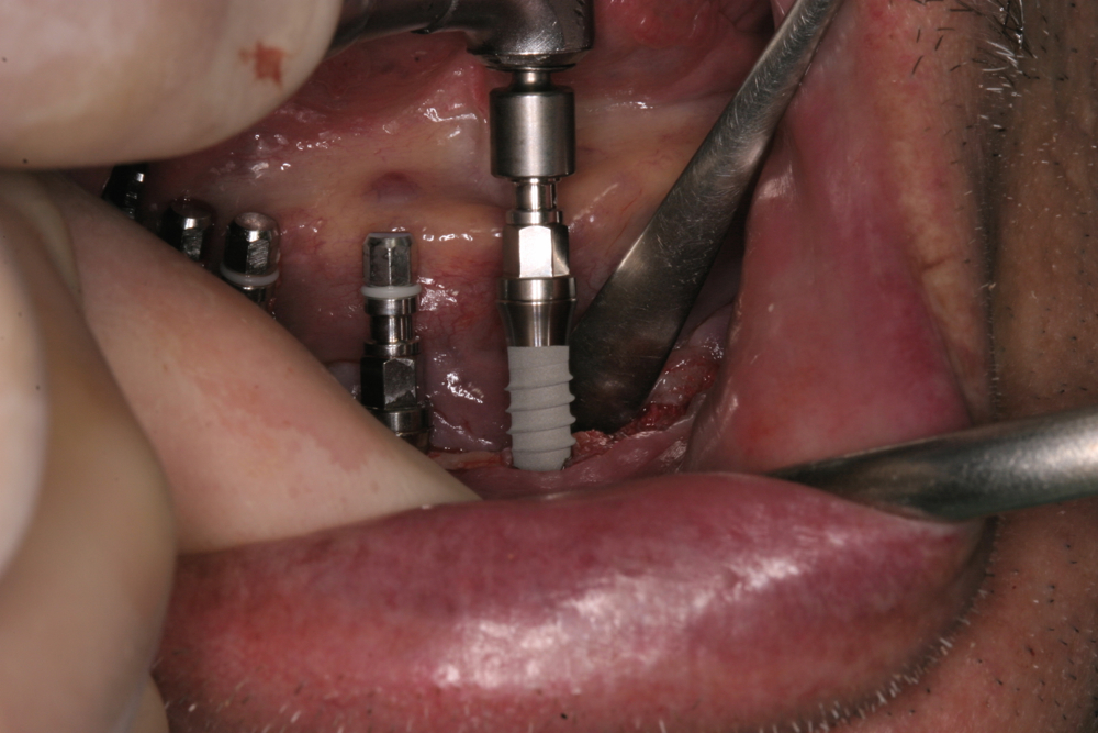 Implant surgery