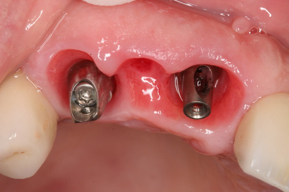 Gum sculpting around implants