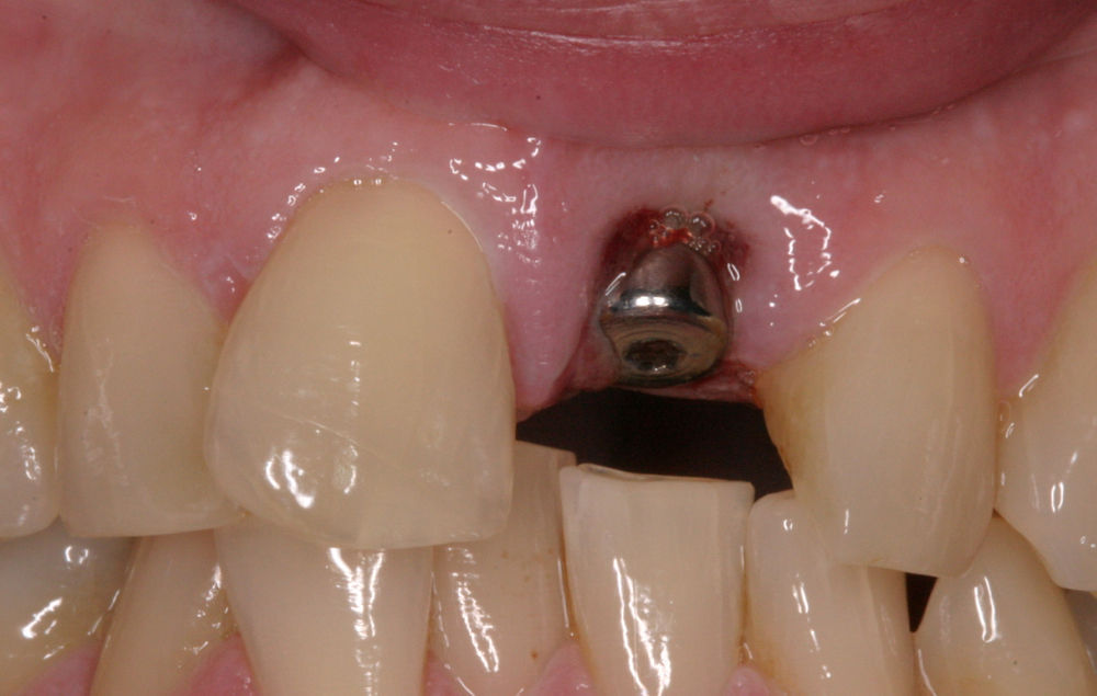 Immediate implant front tooth