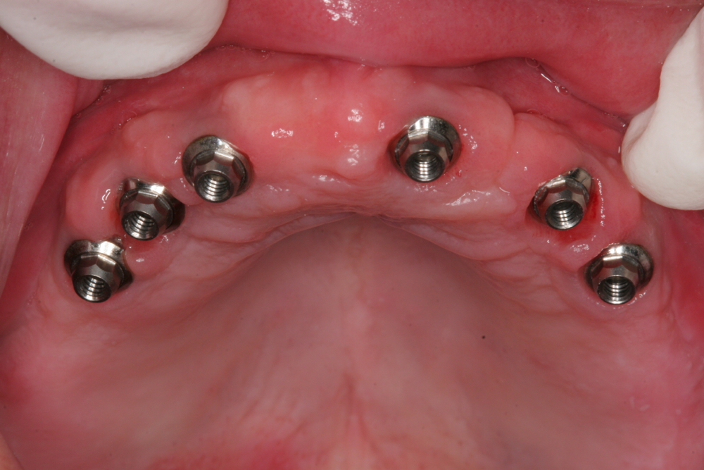 Implants with abutments ready