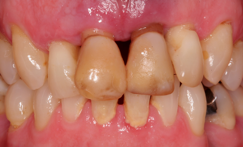 4 upper front teeth failing