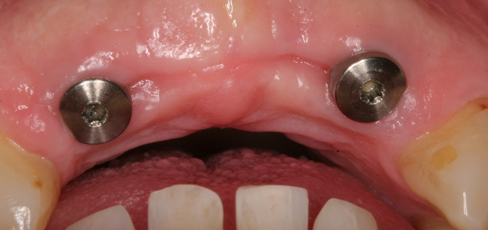 2 implants ready to support a bridge