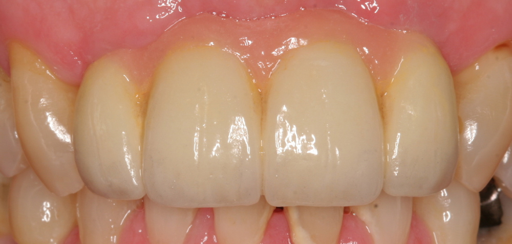 Implant bridge