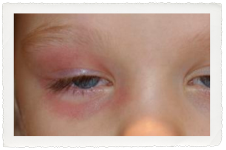 Periorbital cellulitis - this rim of redness that circles the entire eye needs immediate attention