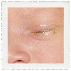 Blocked Tear Duct in a newborn