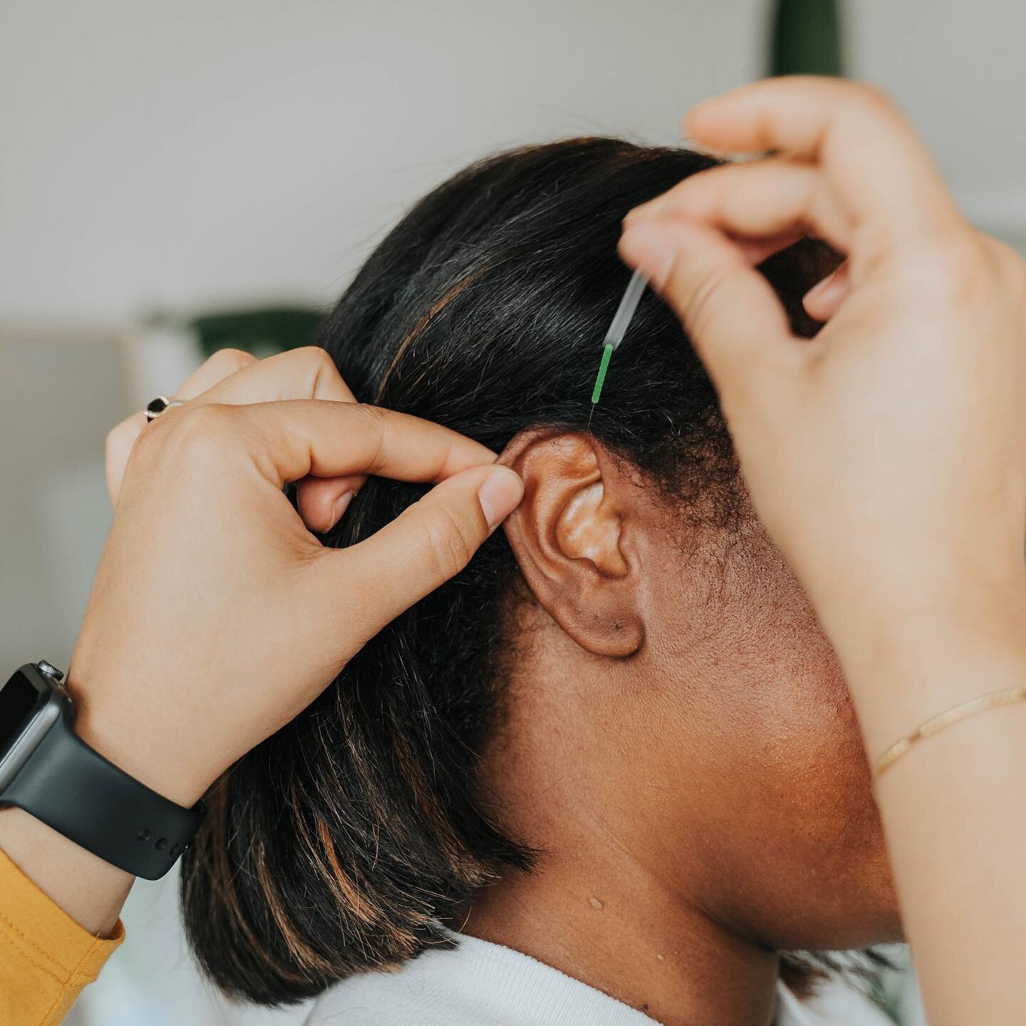 👂Acupuncture at my ears!? Say what!!! 
👂🏾Ear Acupuncture or Auriculotherapy can be used to treat the whole body. There is an entire microsystem on the ear that can be used in treatments. 
👂🏻 You may have experienced needles at your ear during se
