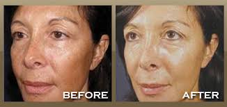 sun damaged and hyperpigmented skin