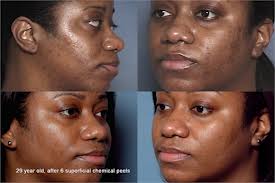 uneven and pigmented skin
