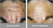 wrinkles, aging , hyperpigmentation, and sundamage