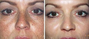Progressive peel