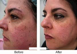 photodamaged, rosacea and acneic skin