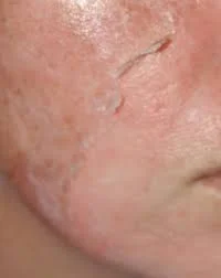 mid-depth peel