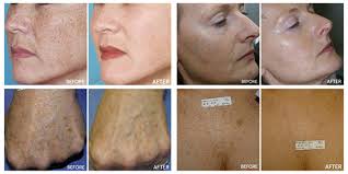 pigmentation and brown sun spots