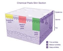 chemical peel penetration in the skin