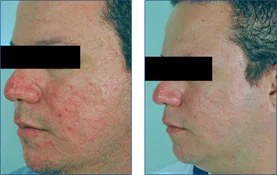 Rosacea and broken capillaries
