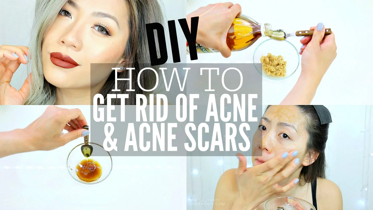 HELLO THERE! Well friends, it’s official the martians have landed and procreated on my face, leaving their ugly ancestors behind (aka. Acne scars!) So I discovered this easy DIY Face mask and scrub that has helped me with fading acne scars and preventing more breakouts and those massive cystic pimples!