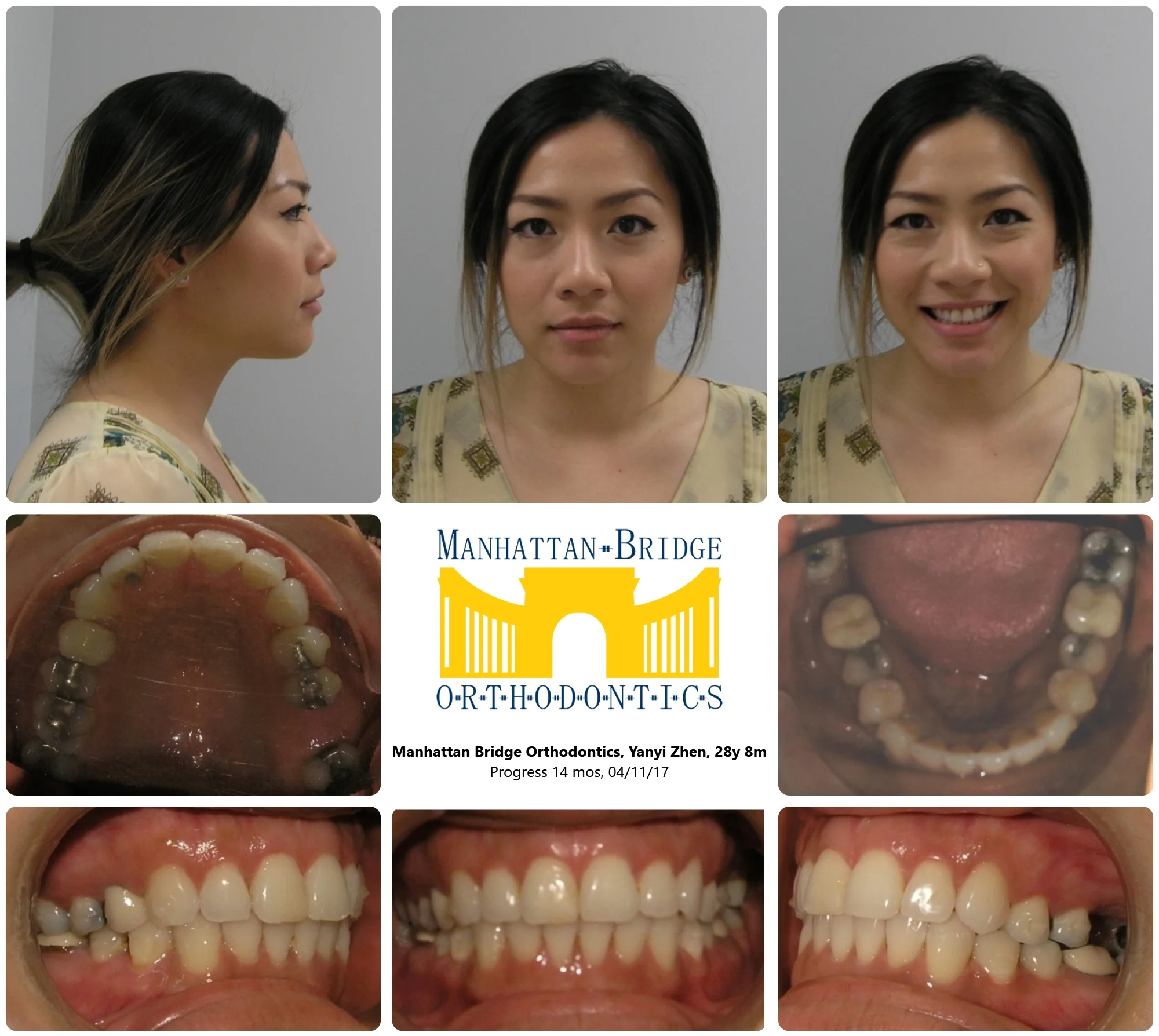 AFTER (14 months later)