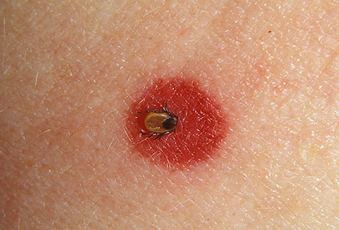 A tick bite. Image source webmd