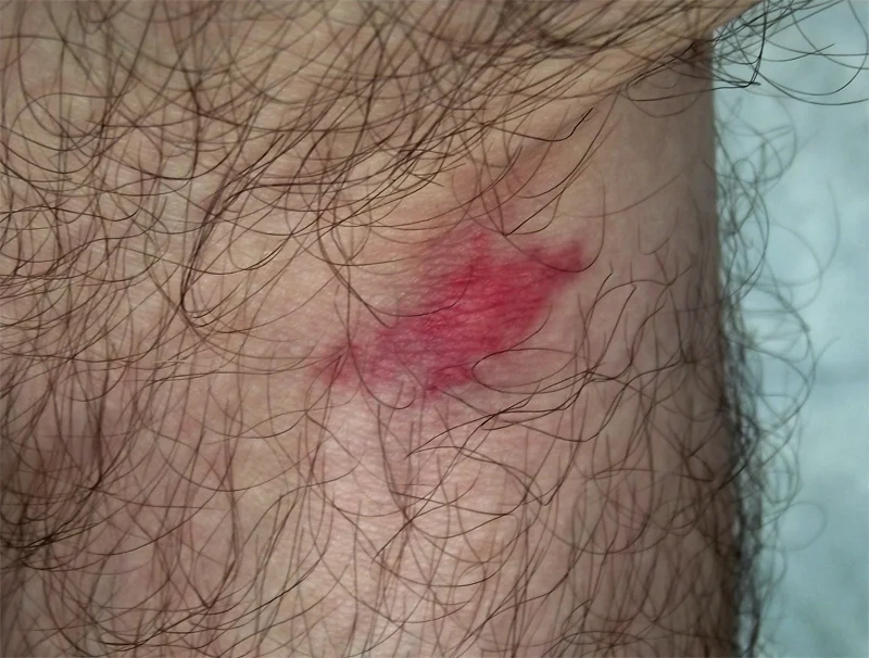 A horse fly bite. Image source Wikipedia