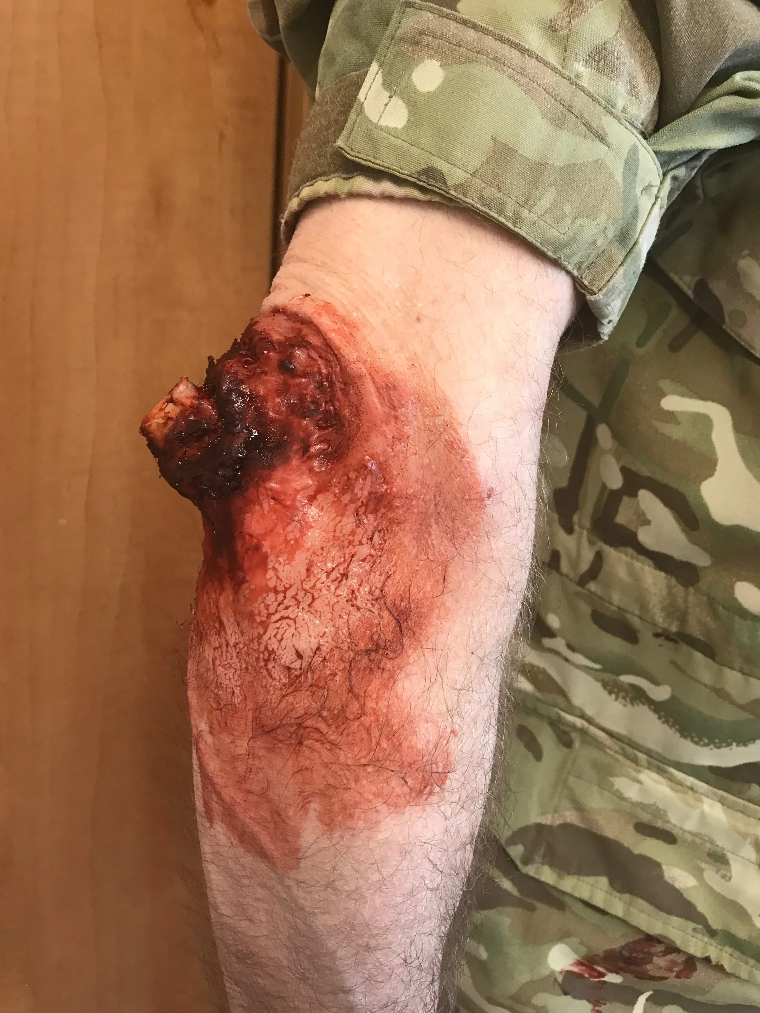 Broken Bone Arm Fracture.jpg