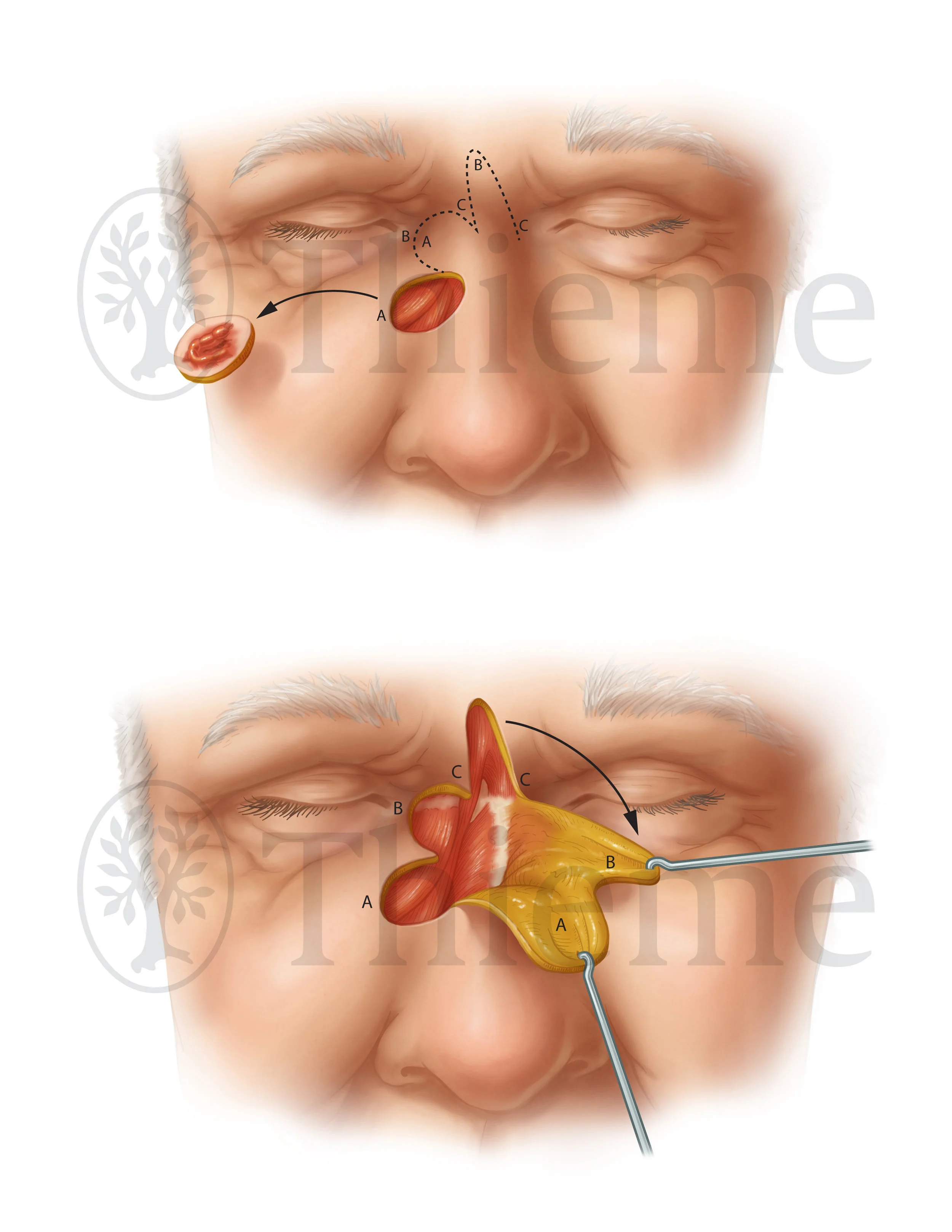 Biolobed Flap Repair