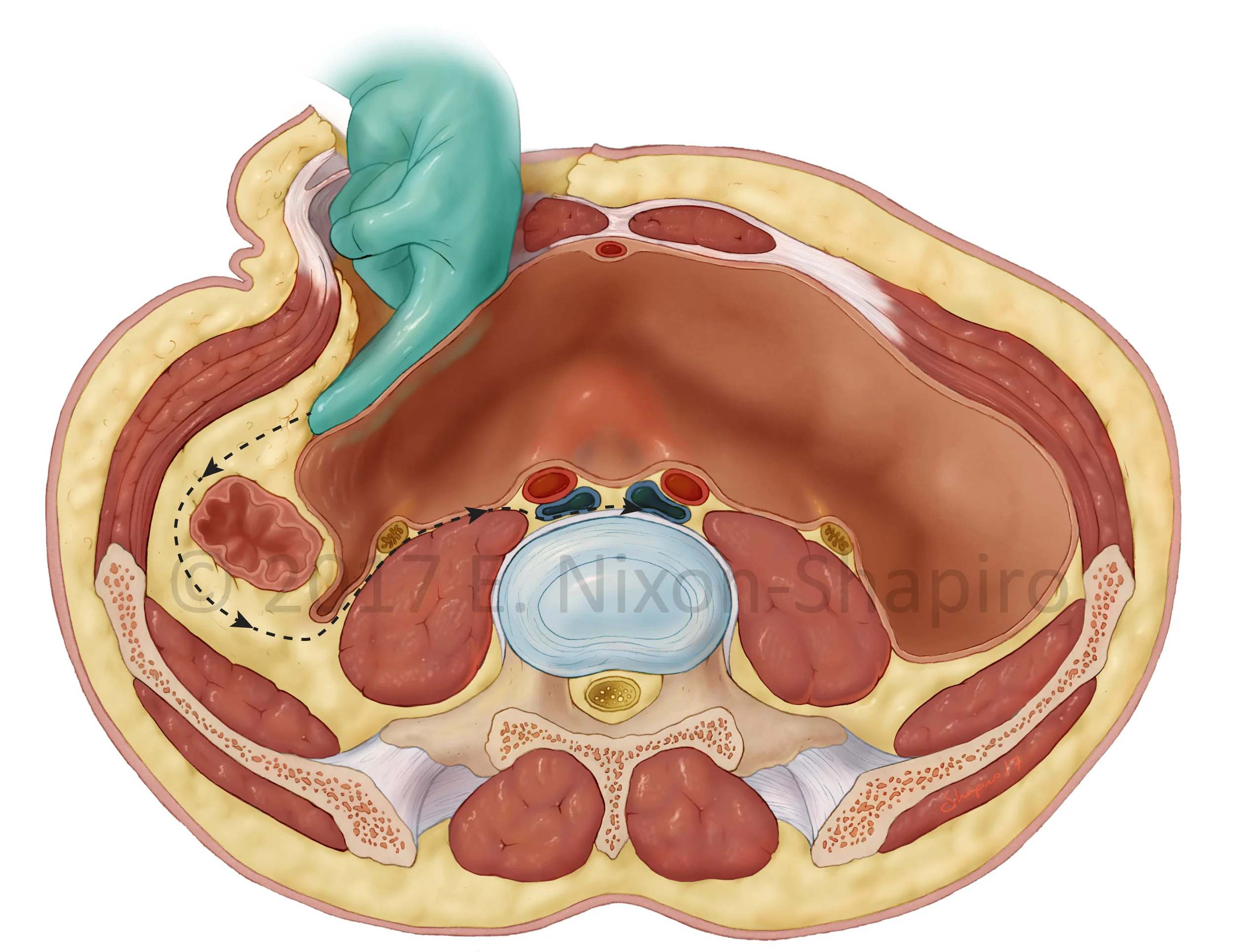 Approach for Anterior Lumbar Interbody Fusion (ALIF).