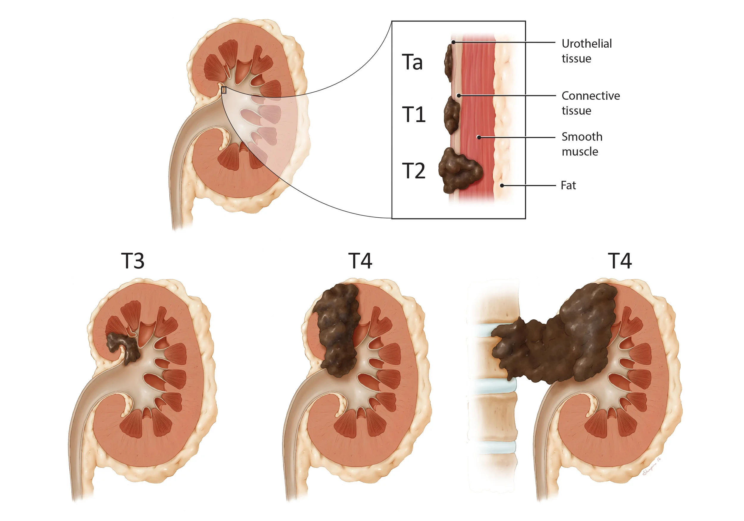 Stages of Urothelial Cancer