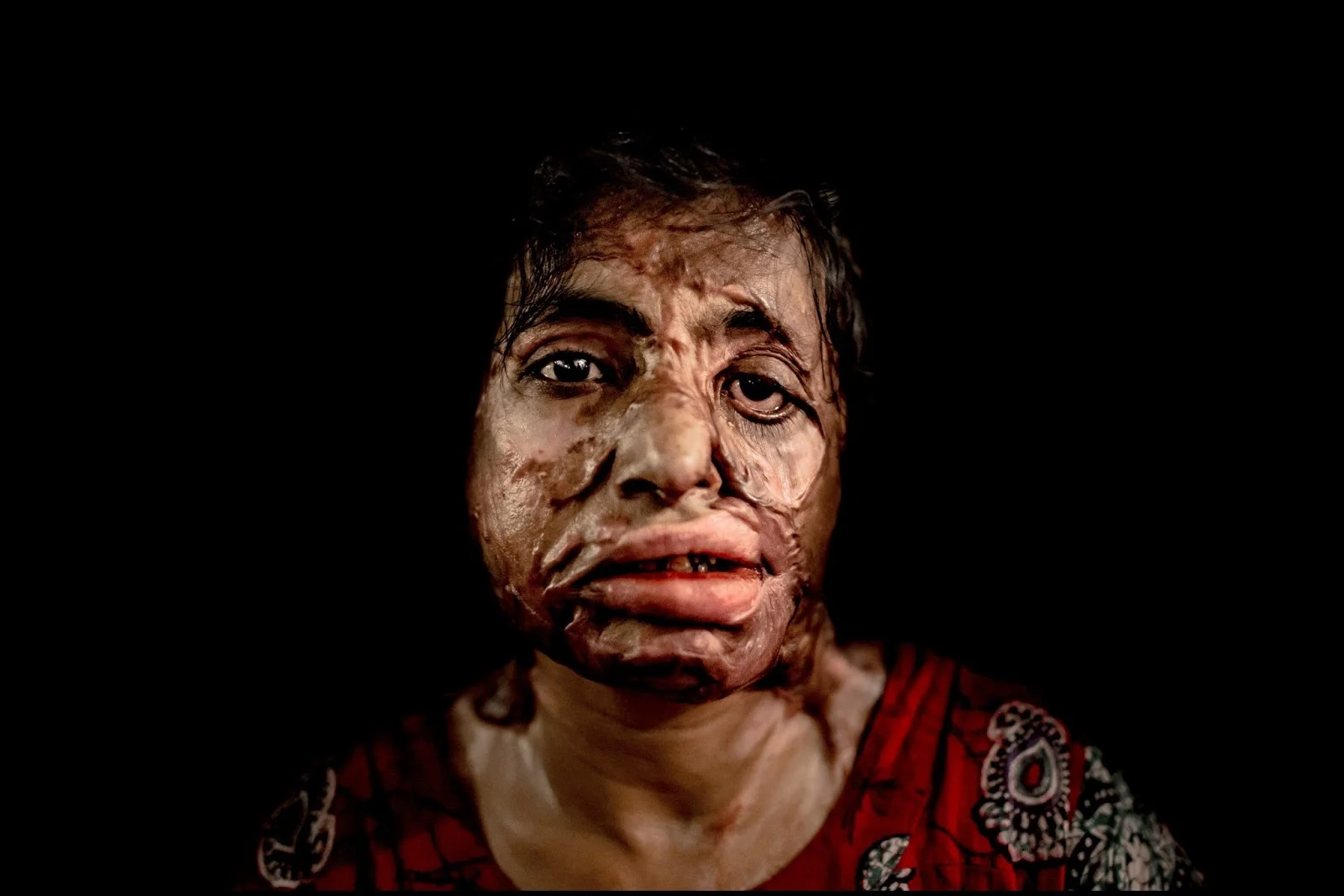 Women Around The World: A Closer Look At Acid Attacks