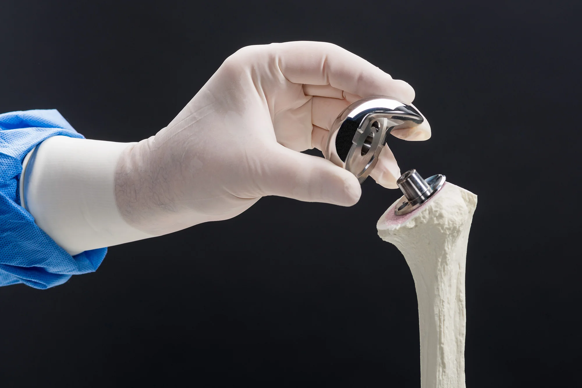 Univers Cuff Arthropathy Head Surgical Technique with Brad Ray, MD
