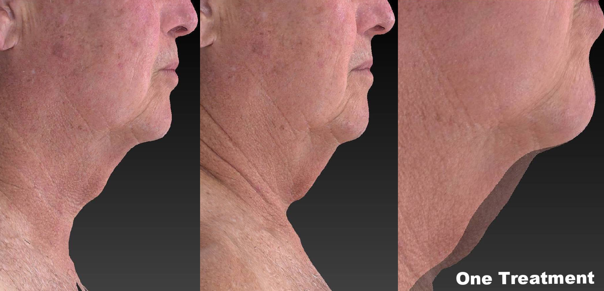 Face at 1 visit side.png