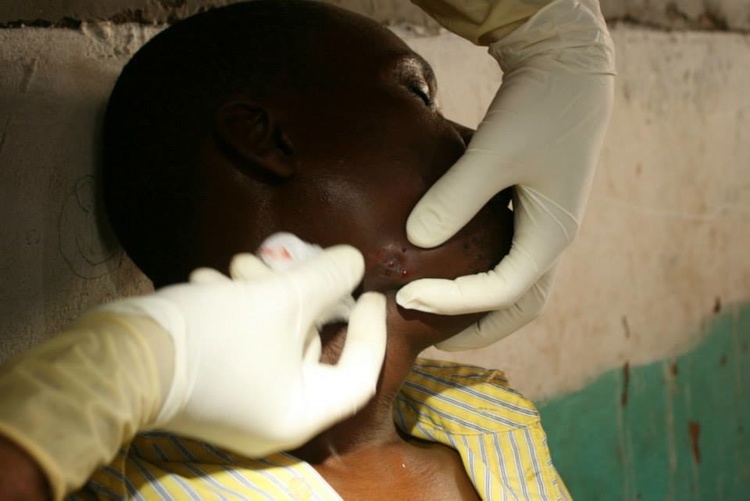   Alberto treating a man whose infection was so severe, it erupted through his cheek.  