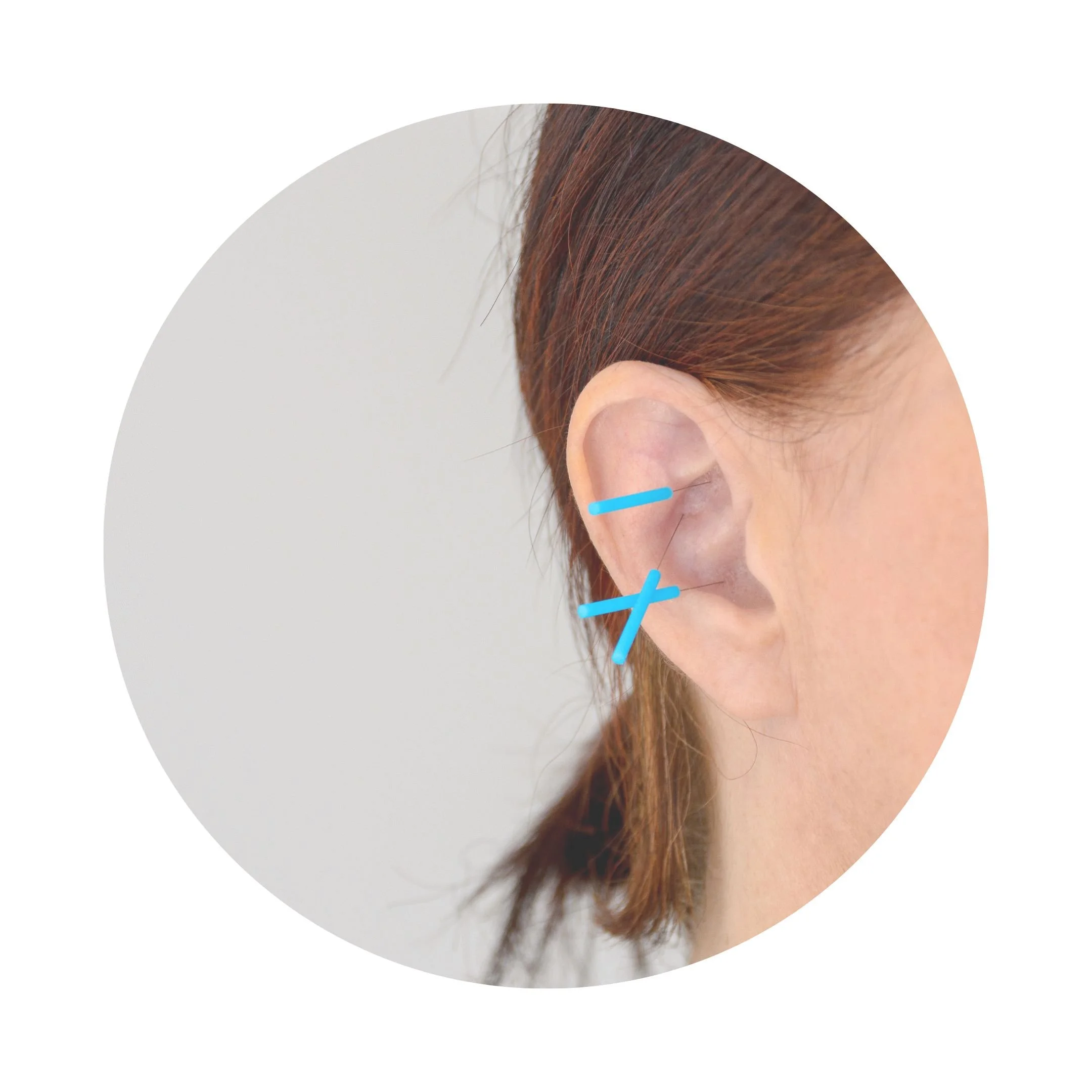 Activating the Ear: Auricular Acupuncture