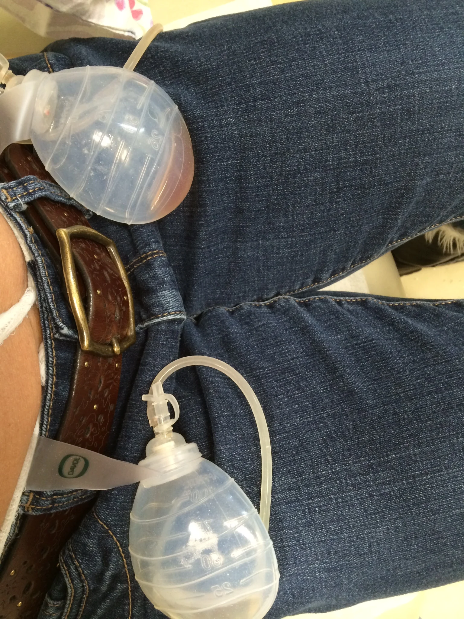 The lovely drains I got to wear for two weeks post-exchange.
