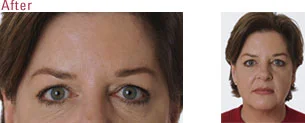 botox_after_1.jpg
