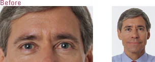 botox_before_2.jpg