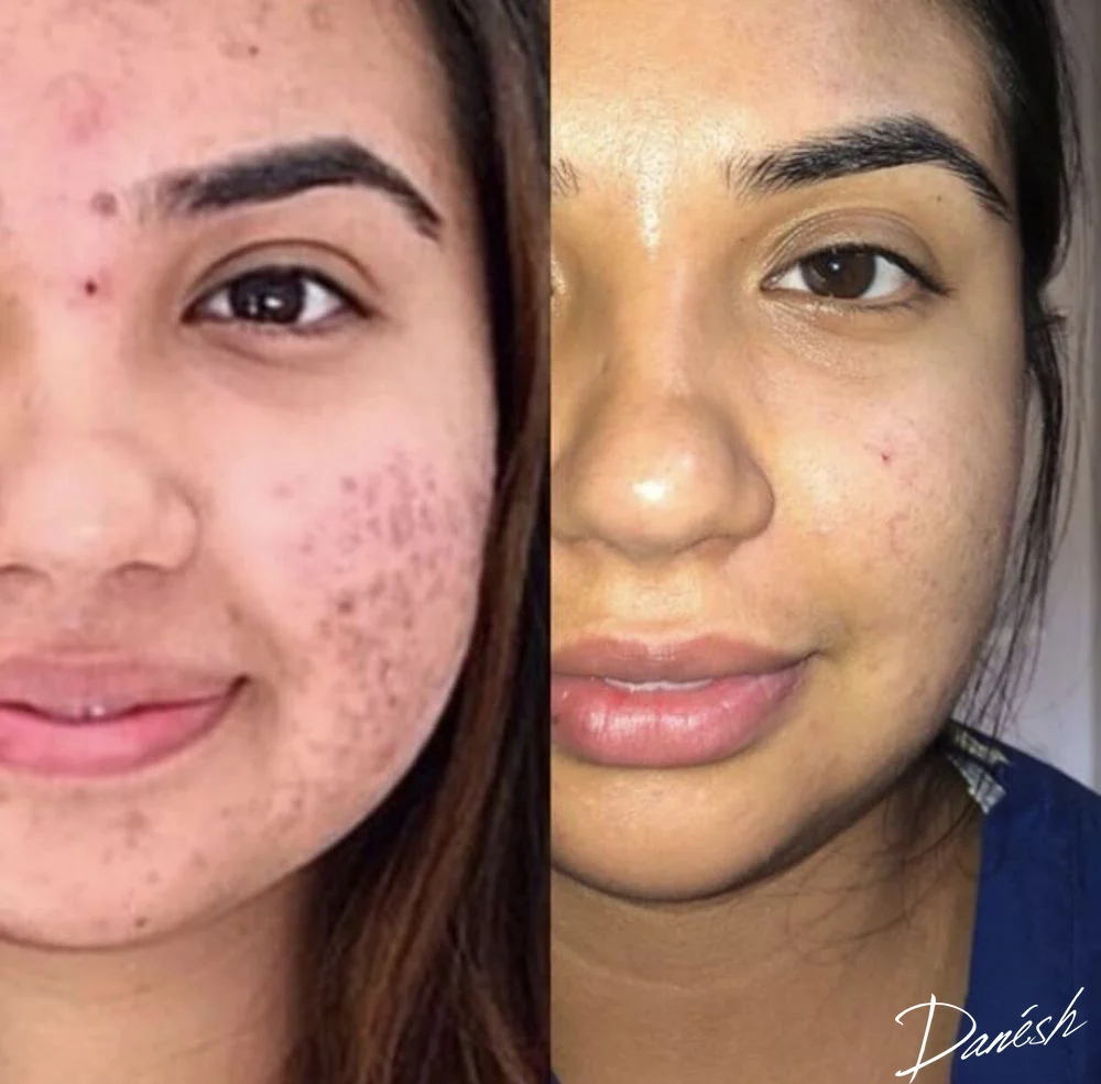 1 - Before and After- Sid Danesh Dermatology Beverly Hills Acne.jpg