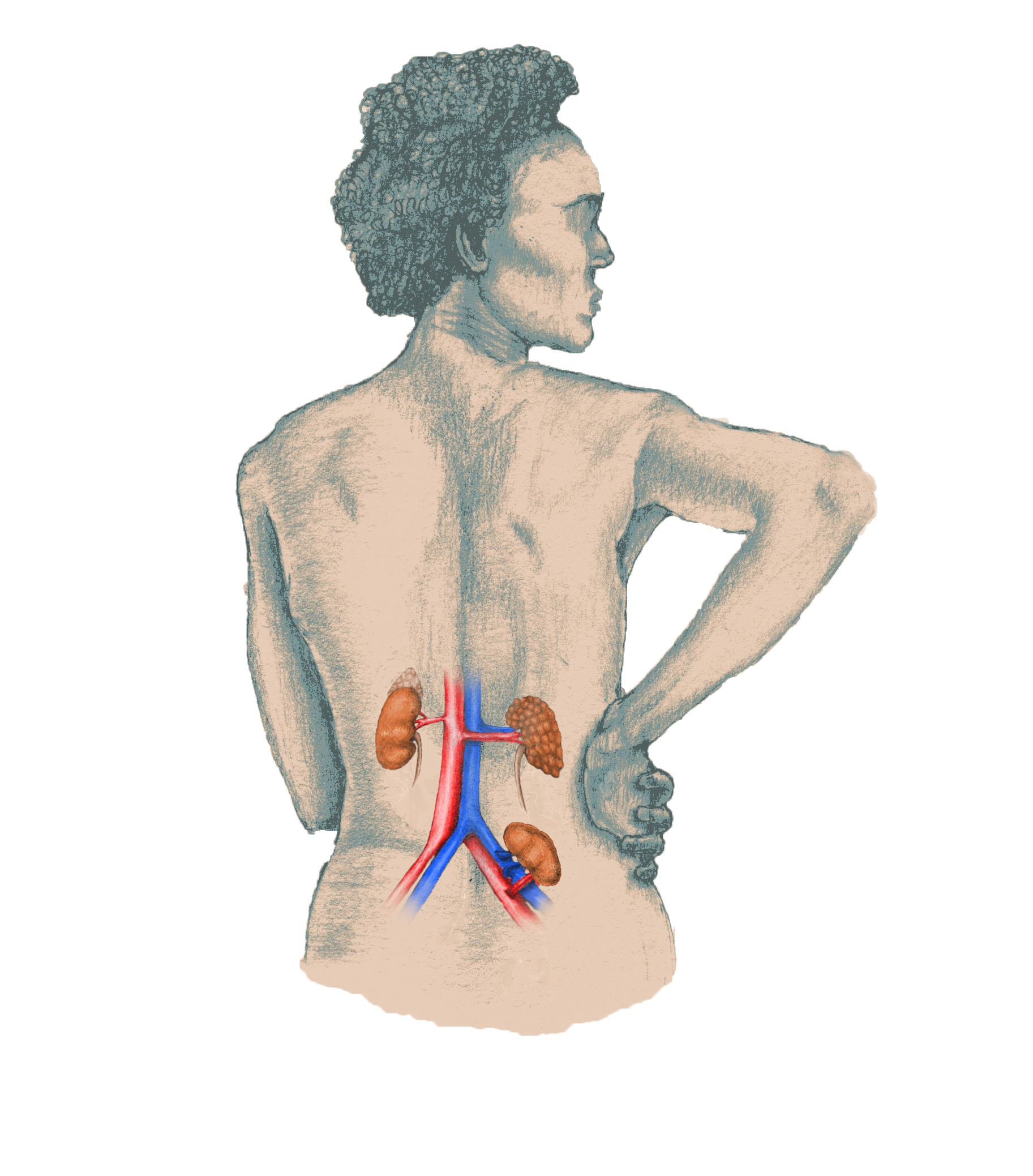 kidney transplant 1.jpg