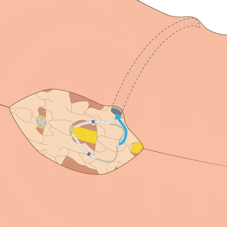 Medical Device IFU [GTX medical]