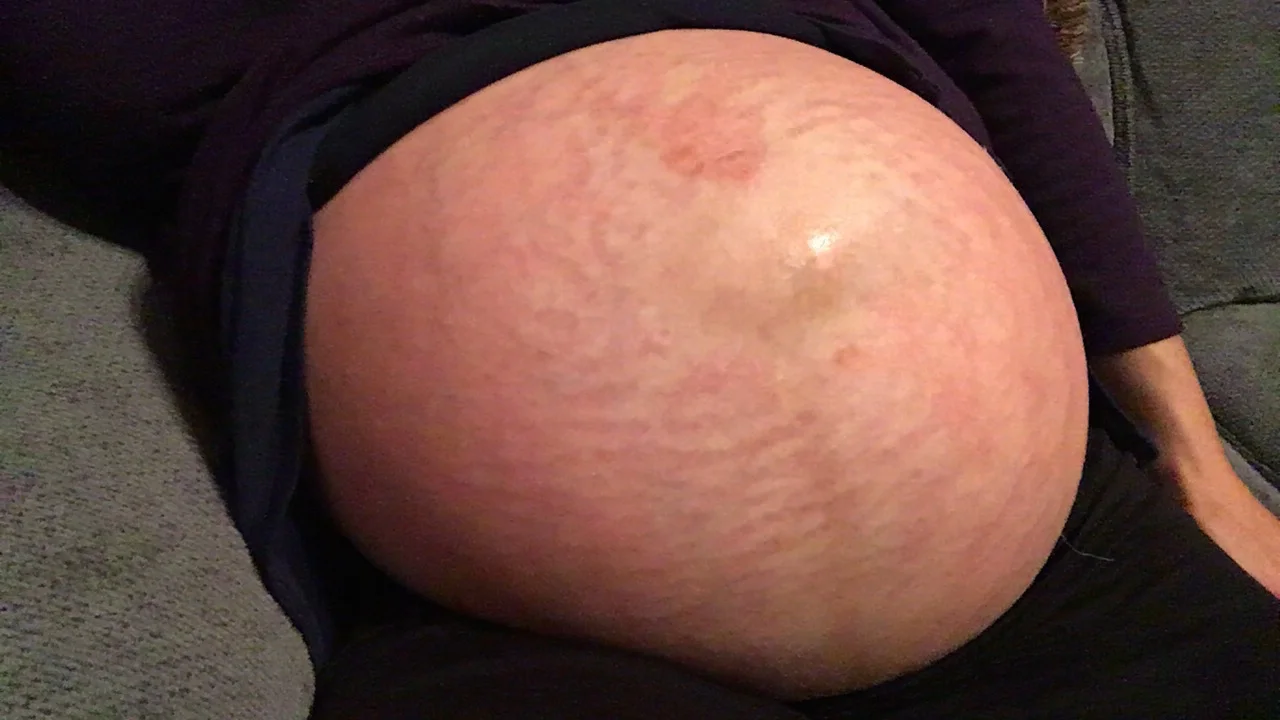 40 weeks with stretch marks and redness