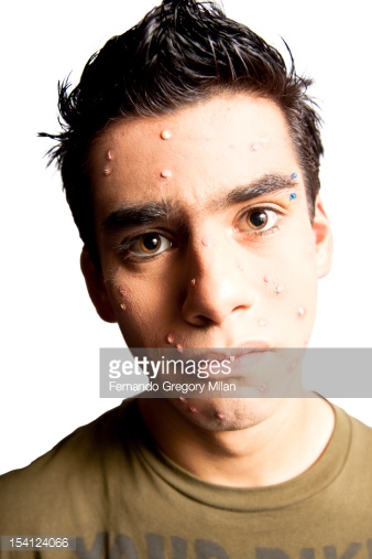 But Didn’t His Acne Clear Up Beautifully!