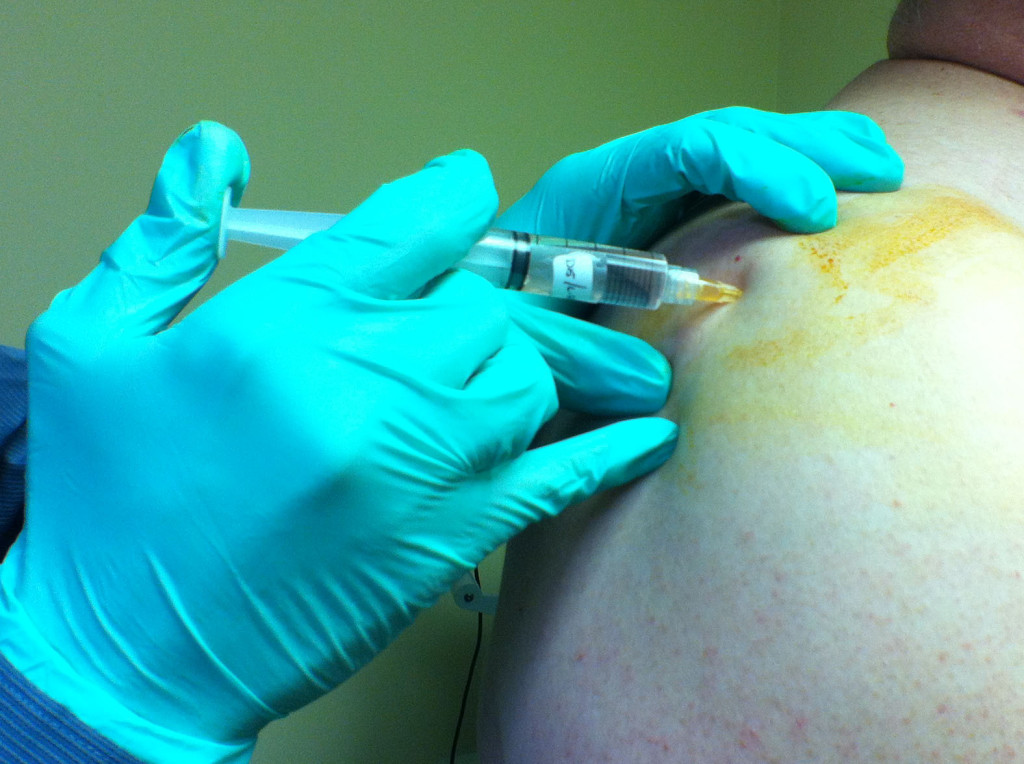 Prolotherapy-and-Shoulder-Pain-1024x764.jpg