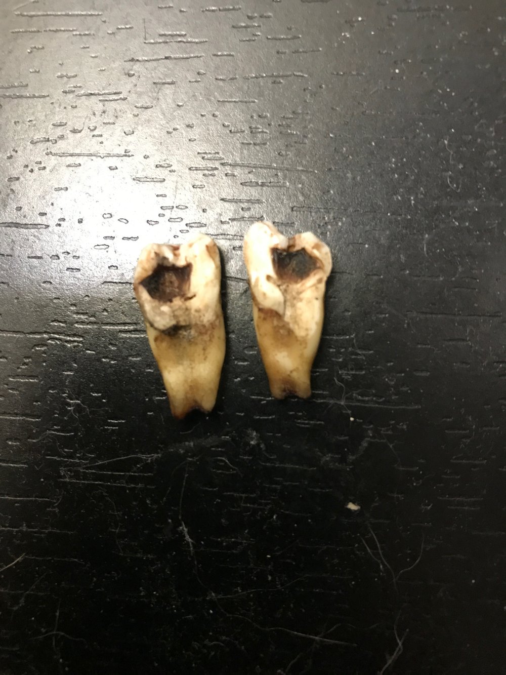 1st Tooth Removed (split to be removed)