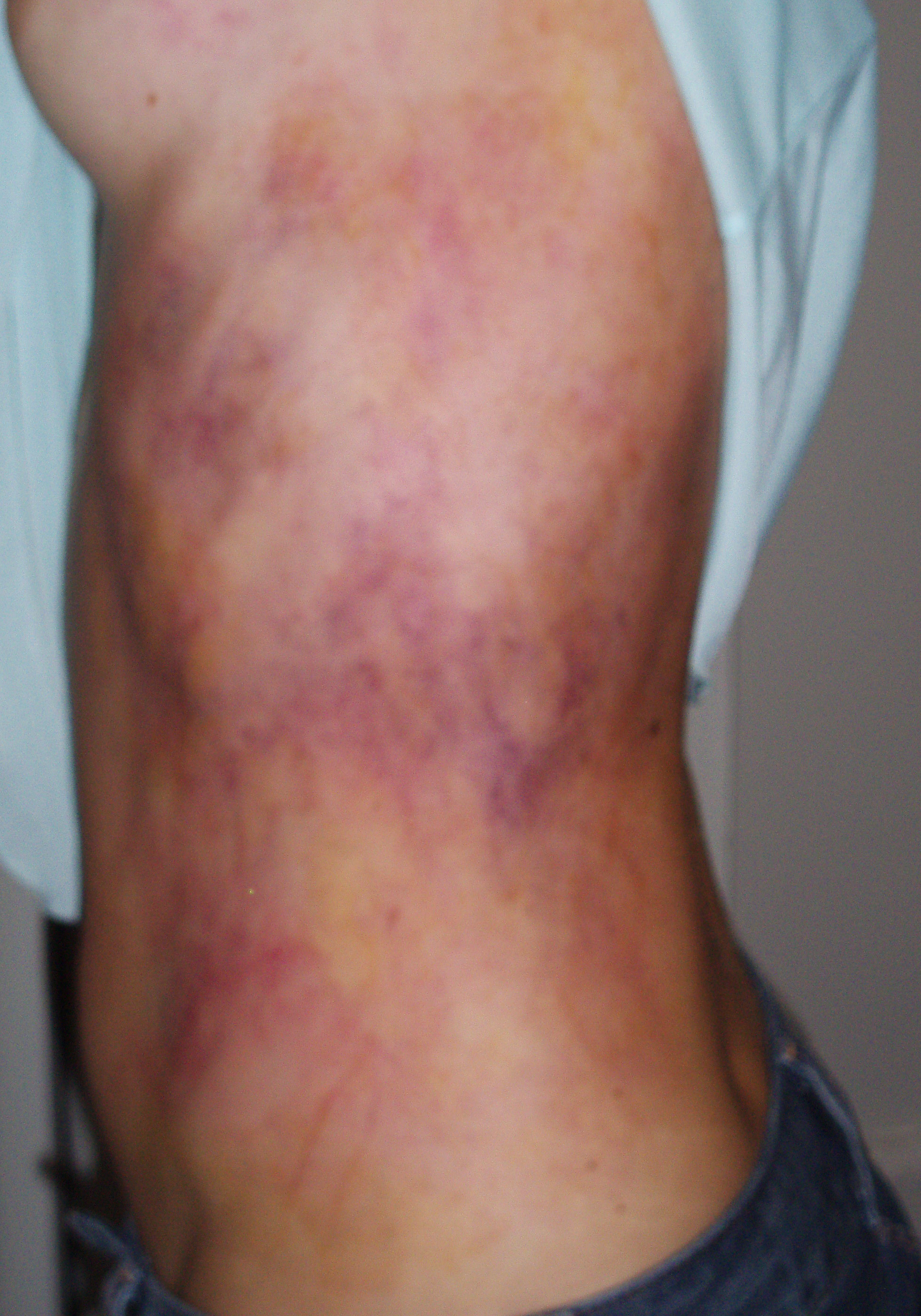 Body Bruises