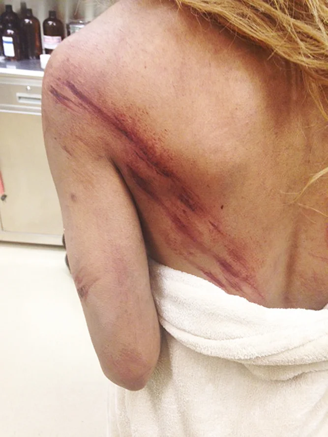 Scrapes from tree branches