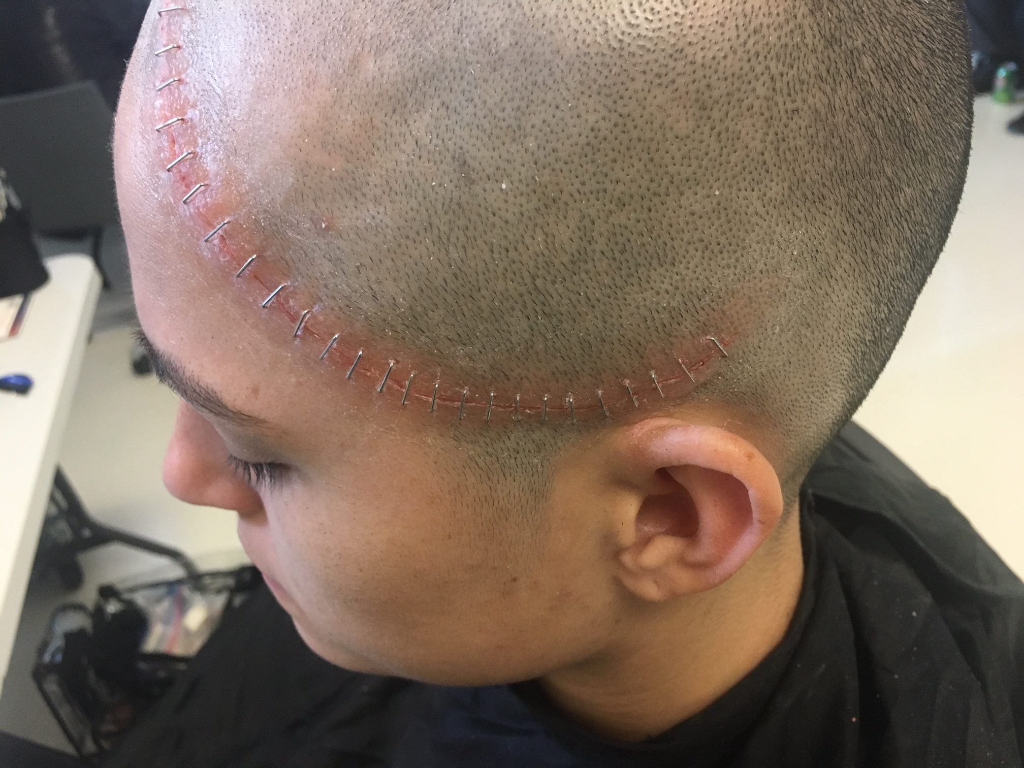 Unpainted 'brain surgery scar'