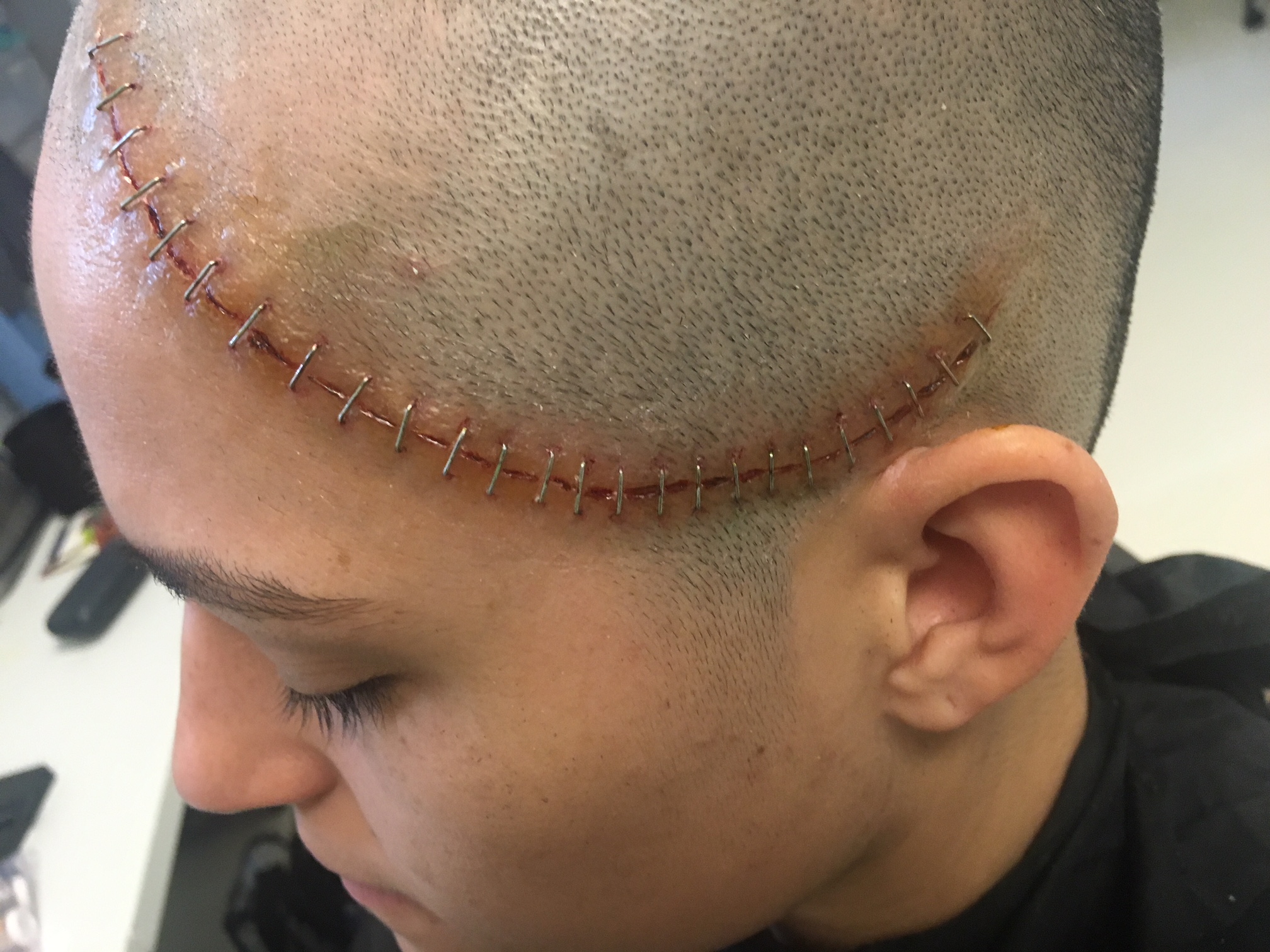 Painted 'brain surgery scar'