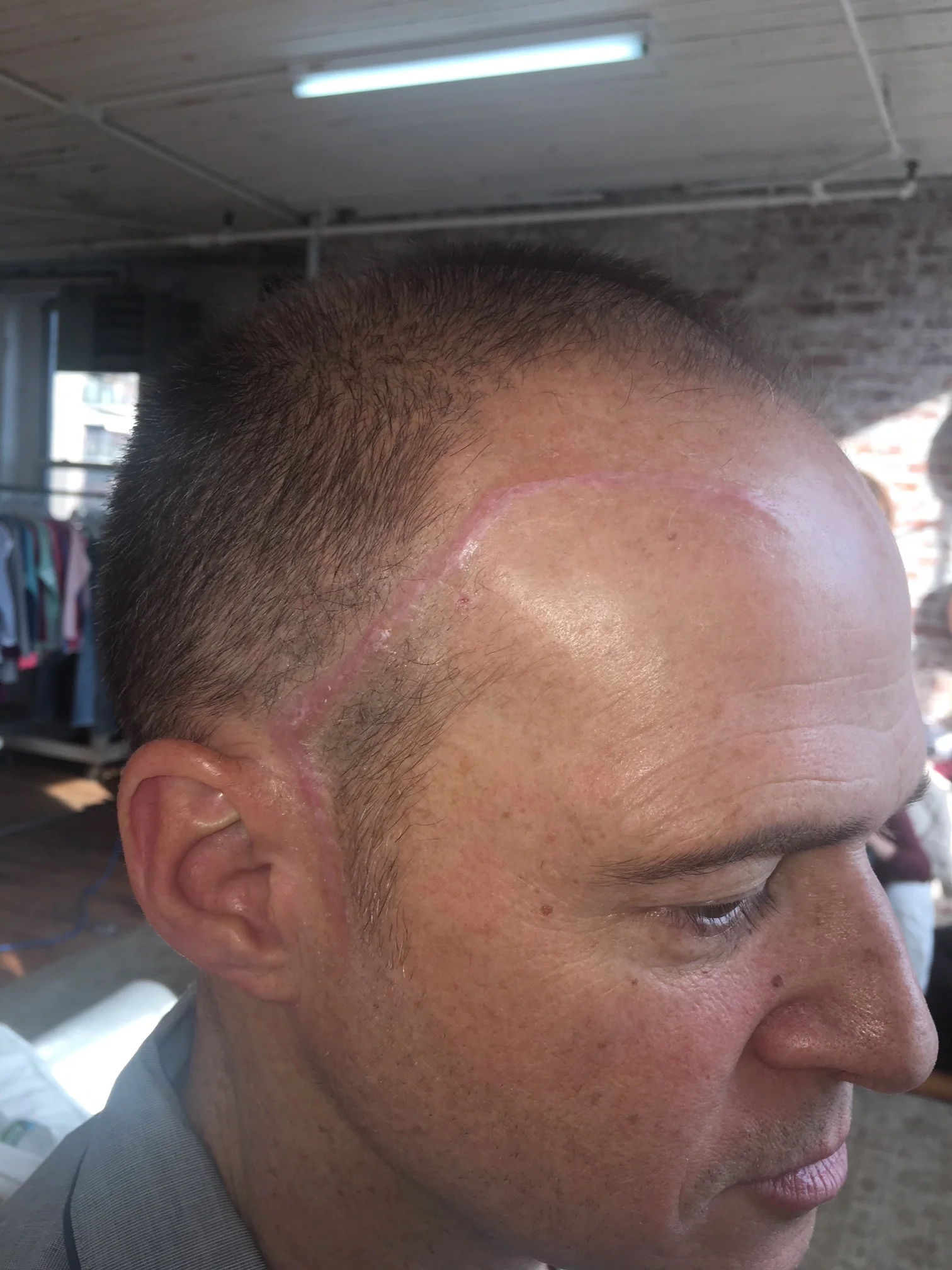 Brain Surgery Scar